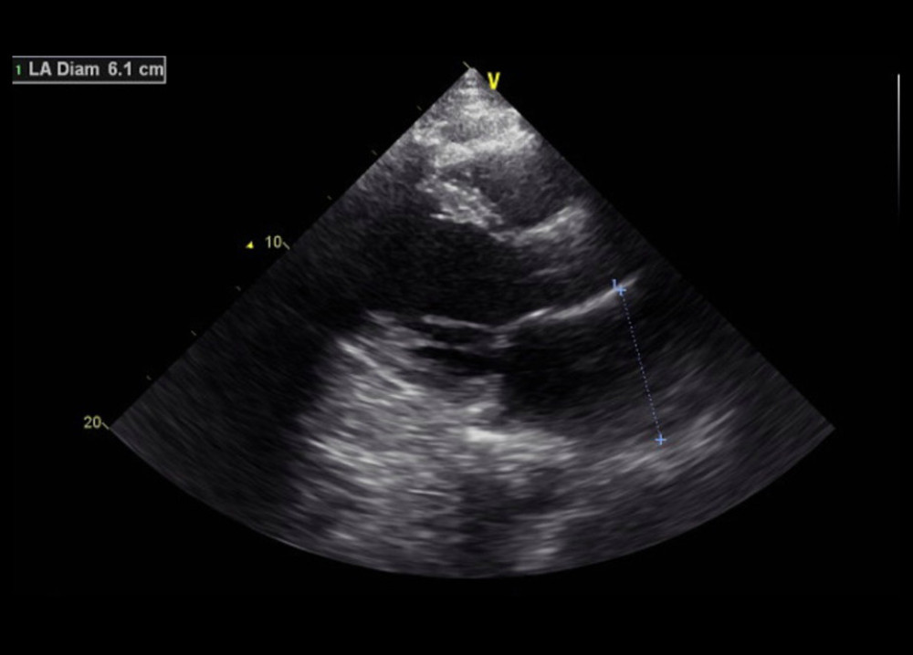 Case 1: Echocardiogram of the 29-year-old son on hospital admission in 2020. It shows elevated left atrial diameter to 6.1 cm (normal is 4.1 cm in males).