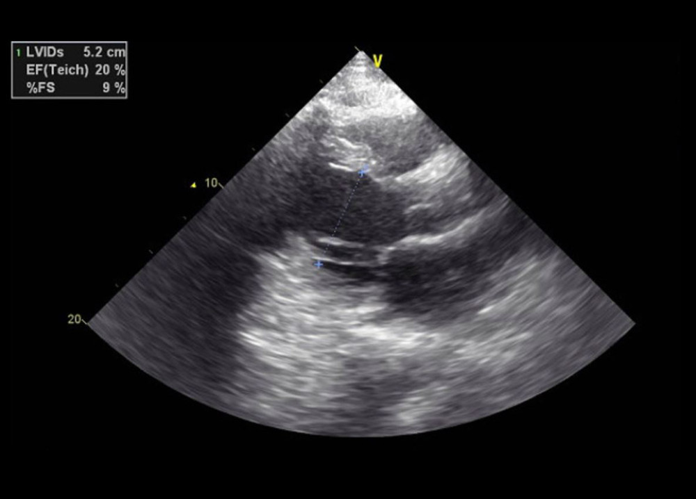 Case 1: Echocardiogram of the 29-year-old son on hospital admission in 2020. Elevated left ventricular internal diameter at end-systole (LVIDs) to 5.2 cm (normal range, 2–4 cm).