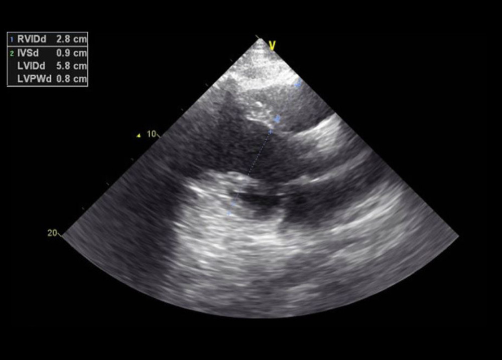 Case 1: Echocardiogram of the 29-year-old son on hospital admission in 2020. It shows elevated enddiastole right and left ventricular internal diameters.