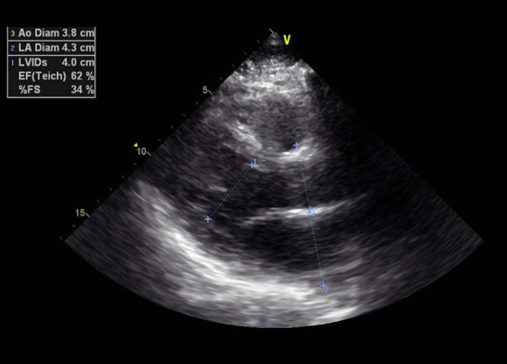 Case 1: Echocardiogram of the 29-year-old son in 2015. It shows normal left ventricular internal diamet