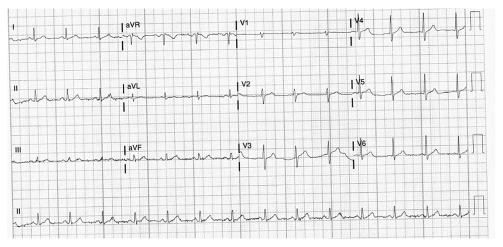 Case 2: EKG of the 54-year-old father on hospital admission in 2020. It shows sinus rhythm with a rate of 84 beats per min.