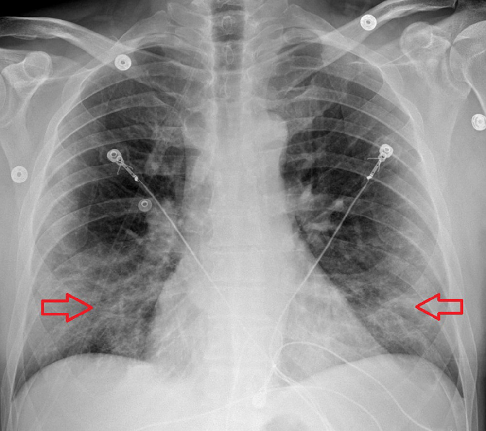 Case 2: Chest X-ray of the 54-year-old father. It shows patchy bibasilar opacities.