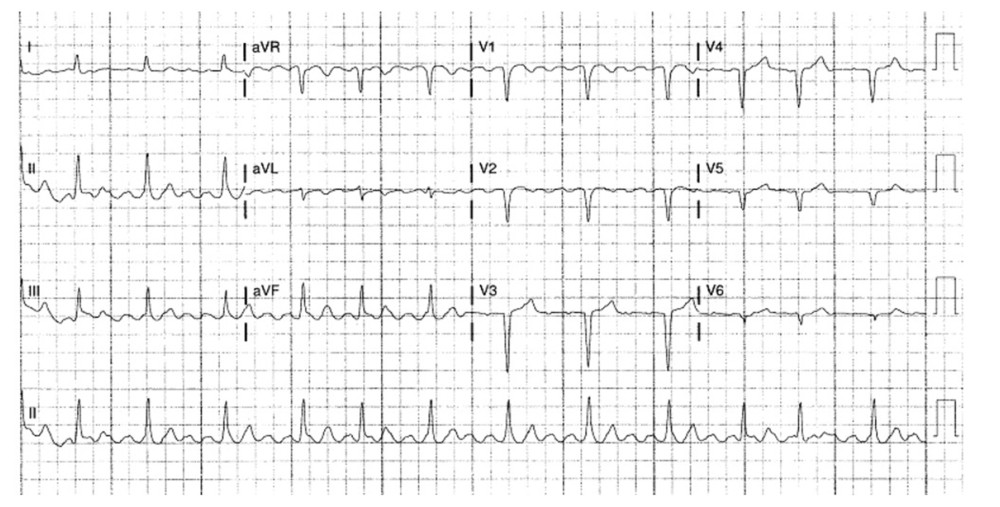 Case 3: EKG of the 84-year-old grandfather. It shows atrial flutter with a varied AV block and a rate of 71 beats per min.