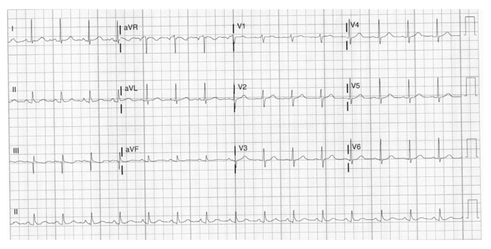 Case 4: EKG of the 79-year-old grandmother. It shows sinus rhythm with a heart rate of 94 beats per min.