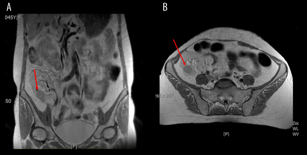 MRI of the abdomen. (A) MRI of the abdomen, frontal view; the tumor of the renal allograft indicated with red arrow. (B) MRI of the abdomen, saggital view; the tumor of the renal allograft indicated with red arrow.