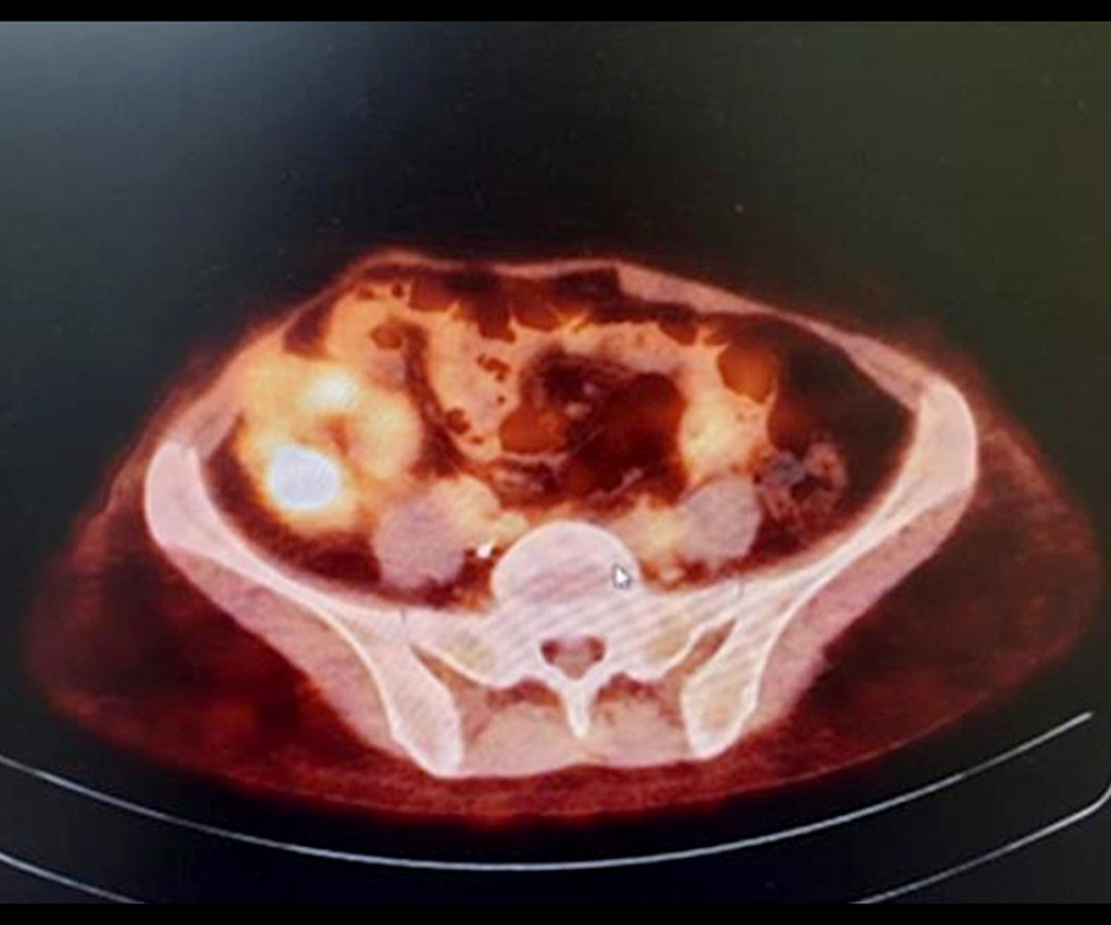 PET-CT. Metabolically active mass in the renal allograft.