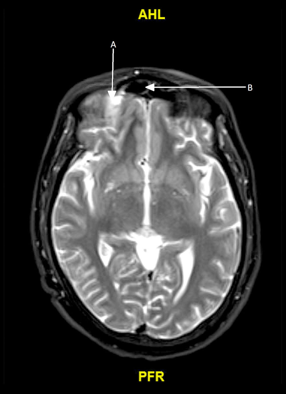 MRI with contrast, on admission. Right inferior frontal lobe T2/FLAIR hyperintensity with contrast enhancement (arrow A), immediately dorsal to the right frontal sinus (arrow B). There is associated leptomeningeal enhancement. Axial T2 fat-saturation (FS) gadoterate meglumine contrast.