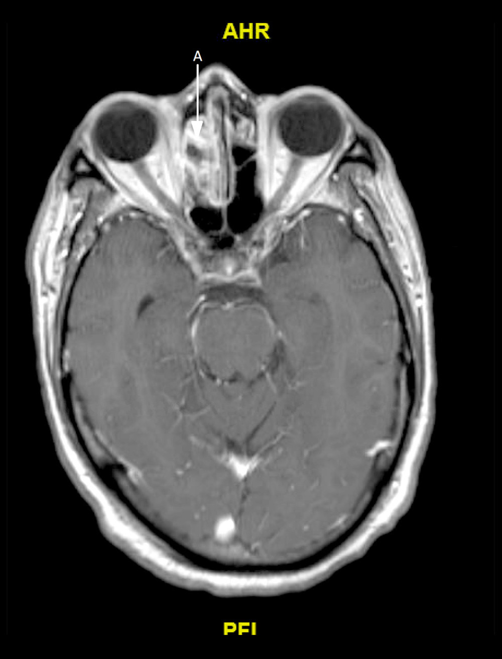 MRI with contrast, on admission. There is near complete opacification and post-contrast enhancement of the right ethmoid sinus (arrow A). Mucoperiosteal thickening is present. Axial T1 (gradient motion rephasing) post-gadoterate meglumine contrast.