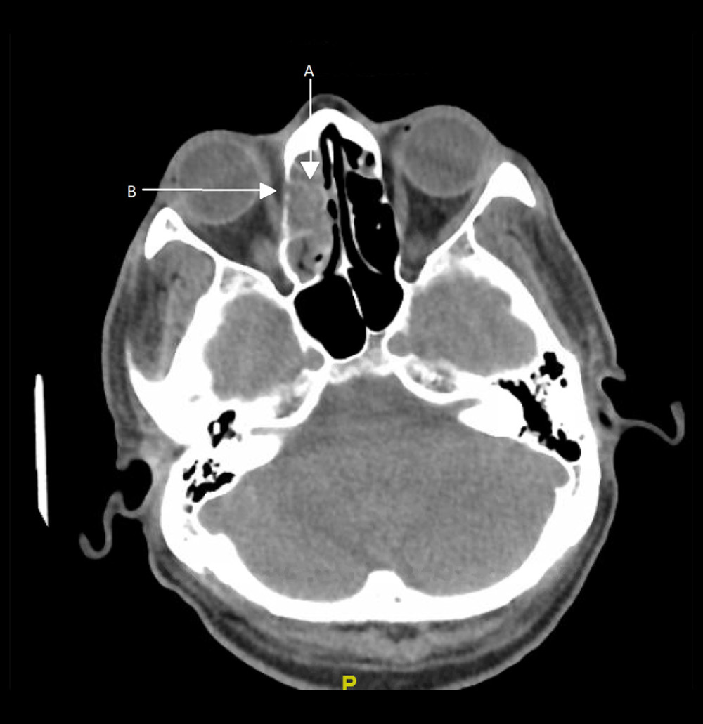 CT Sinus without contrast, Day 3. There is complete opacification of the anterior right ethmoid air sinus (arrow A) with extension into the right superior medial orbit. There are bony erosions of the medial wall of the right orbit (arrow B). Standard Sinus, no contrast.