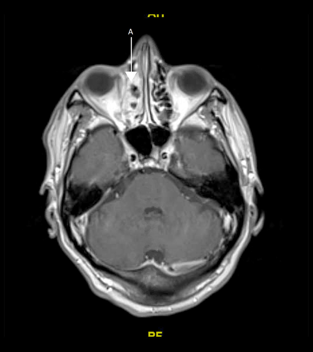 MRI with contrast, Week 3. Redemonstrated complete opacification of the anterior right ethmoid air cells (arrow A) with viscous material. Axial T1 (gradient motion rephasing) post-gadoterate meglumine contrast.