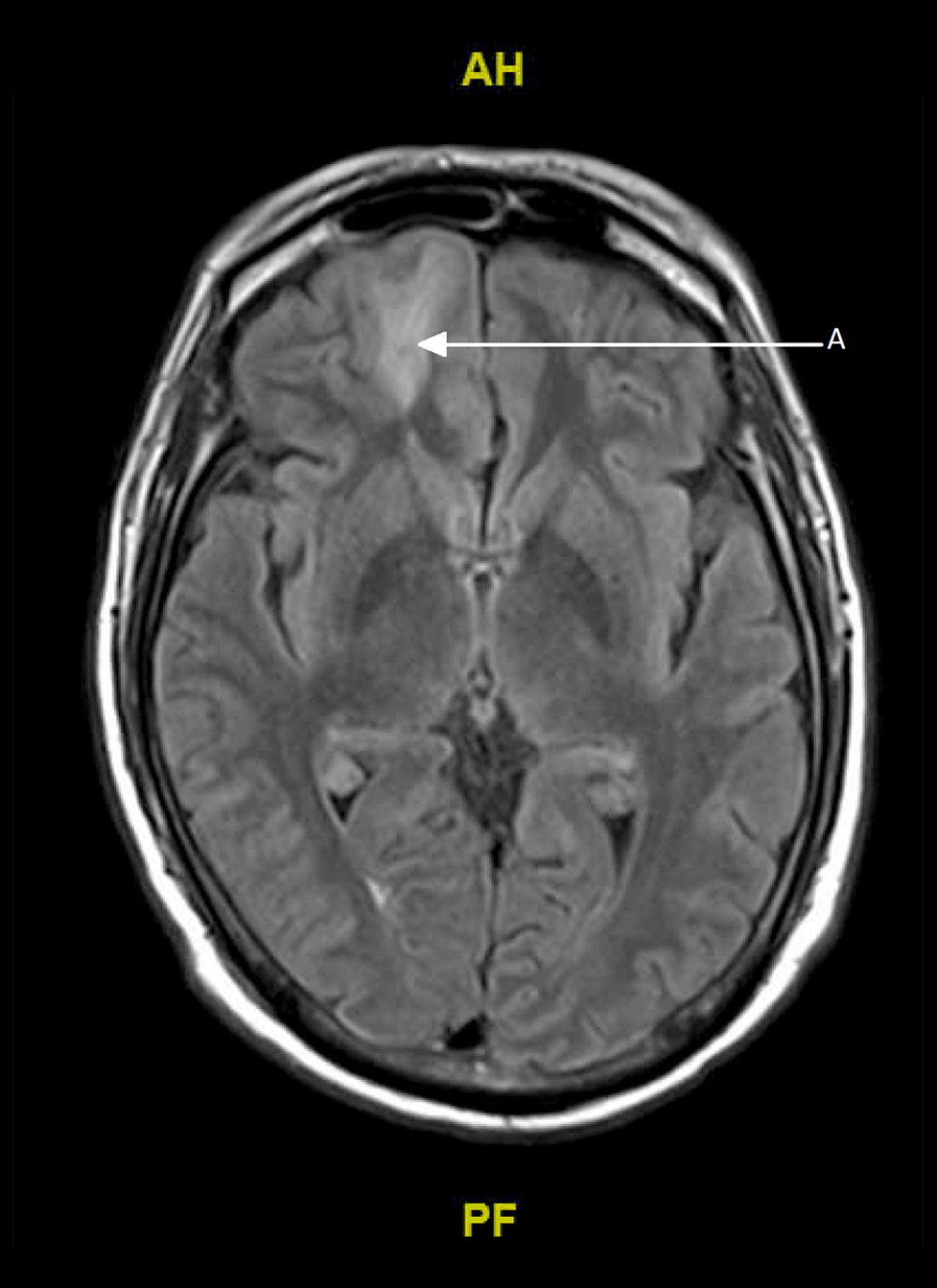MRI with contrast, week 3. Interval increased abnormal T2/FLAIR signal in the right inferior frontal lobe (arrow A) with peripheral contrast enhancement, worsened compared to prior imaging. Axial FLAIR gadoterate meglumine contrast.