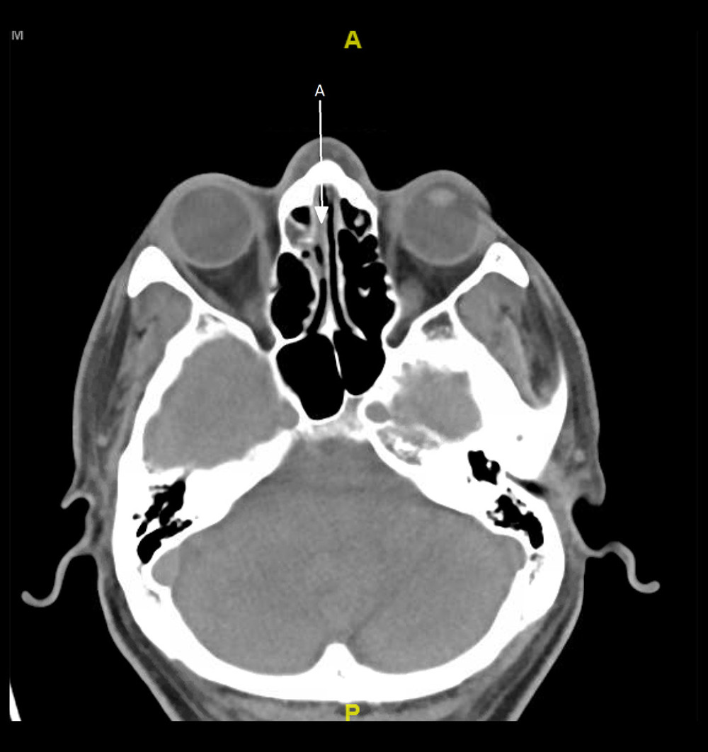 CT face without contrast, week 52. Mucosal thickening of ethmoid air cells (arrow A). Resolution of prior opacification of ethmoid sinus. Axial face soft tissue, no contrast.