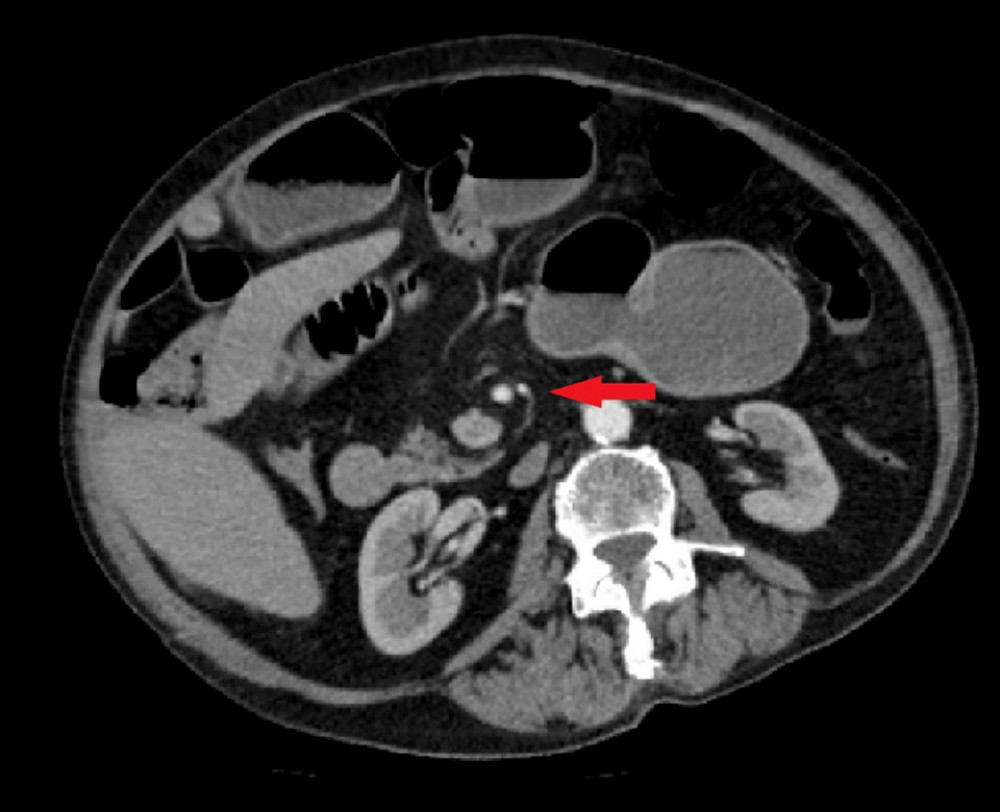 Computed tomography showing multiple dilated loops of small bowel and a “swirl sign” (arrow) that was concerning for midgut volvulus.