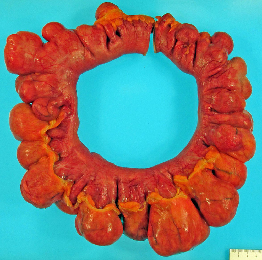 Gross specimen with near-continuous involvement of the small bowel by consecutive gastrointestinal diverticula/pseudodiverticula (up to 6.2 cm) arising from the mesenteric border.