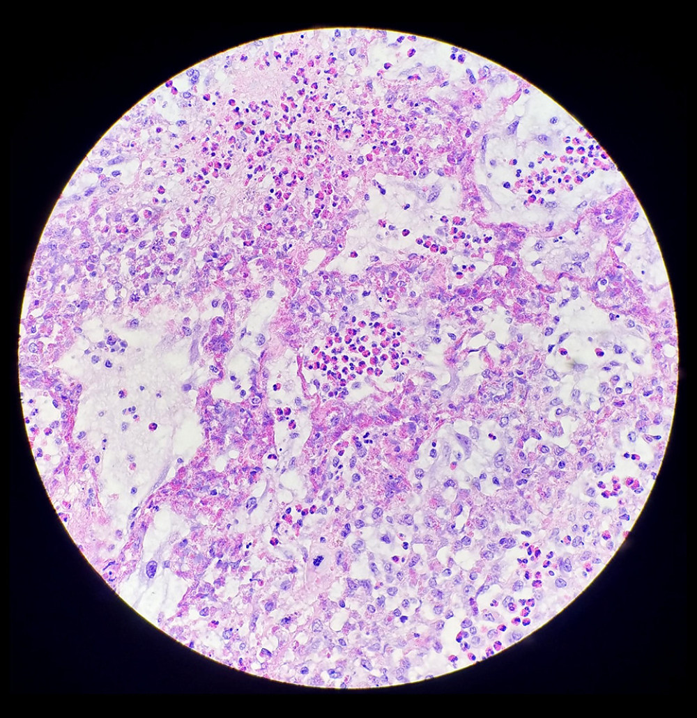 Microscopically, the diverticula show a lack of muscularis propria. There is not prominent crypt loss or crypt destruction; however, there are eosinophils infiltrating the epithelium, deep mucosa, submucosa, and muscularis propria, as described in cases of eosinophilic gastroenteritis.