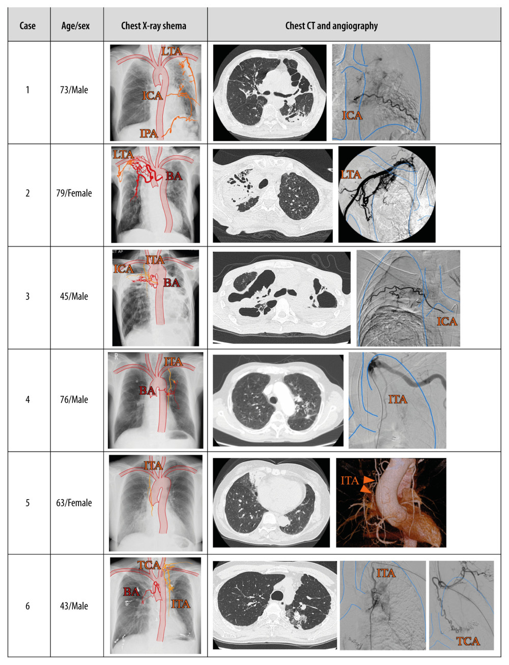Basic information and imaging findings of the 6 cases. All figures were made with GoodNotes 5®, developed by Time Base Technology Limited (London, United Kingdom). BA – bronchial artery; ICA – intercostal artery; IPA – inferior phrenic artery; ITA – internal thoracic artery; LTA – lateral thoracic artery; TCA – thyroid carotid artery.