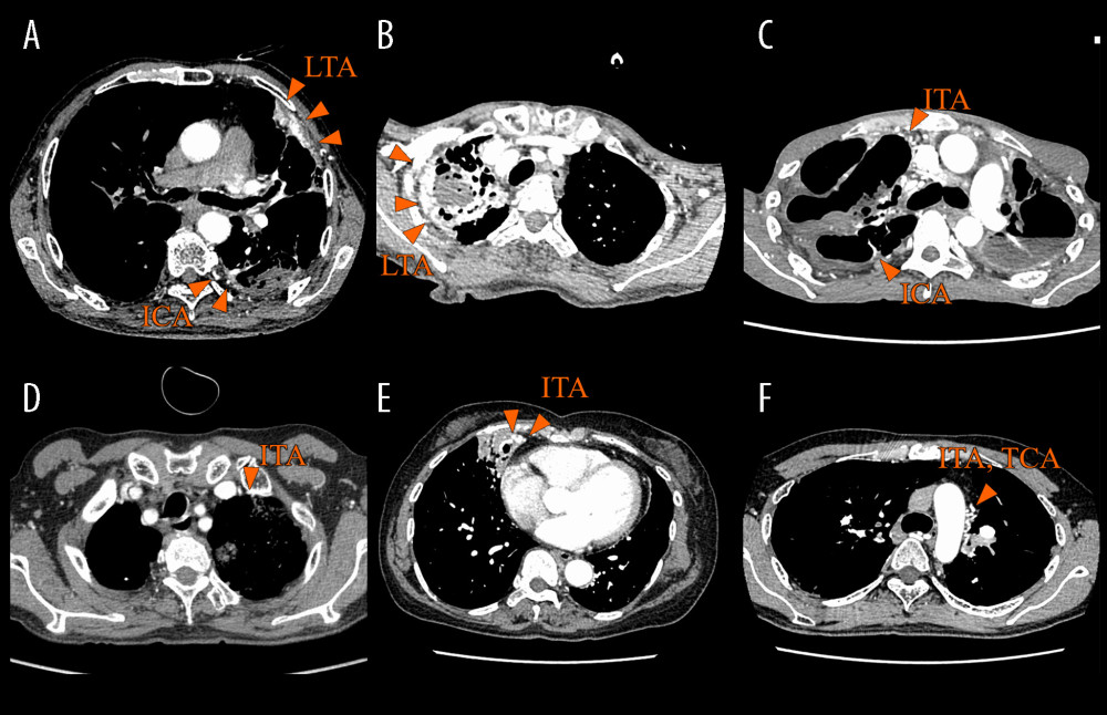 Contrast-enhanced computed tomography (CT) findings and the prediction of non-bronchial systemic arterial supply. (A) Contrast-enhanced CT shows pleural thickening and dilated vascular structures, indicating non-bronchial arterial supply in the left lung upper lobe in case 1 (triangle). (B) Contrast-enhanced CT shows pleural thickening and dilated vascular structures, indicating non-bronchial arterial supply in the right lung upper lobe in case 2 (triangle). (C) Contrast-enhanced CT shows pleural thickening and dilated vascular structures, indicating non-bronchial arterial supply in the right lung upper lobe in case 3 (triangle). (D) Contrast-enhanced CT shows dilated and tortuous vascular structures, indicating non-bronchial arterial supply in the left lung upper lobe in case 4 (triangle). (E) Contrast-enhanced CT shows dilated and tortuous vascular structures, indicating non-bronchial arterial supply in the right lung middle lobe in case 5 (triangle). (F) Contrast-enhanced CT shows dilated and tortuous vascular structures within hypertrophic extrapleural fat adjacent to the medial side of the left lung upper lobe, indicating non-bronchial arterial supply in case 6 (triangle). ICA – intercostal artery; ITA – internal thoracic artery; LTA – lateral thoracic artery; TCA – thyroid carotid artery.