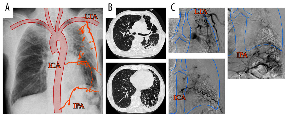 (A) Chest radiography combined with a schema showing increased vascularity. (B) Chest computed tomography shows multiple cavitary lesions in contact with the pleura throughout the left lung and a fungus ball on the dorsal side of the left lung upper lobe. (C) Angiography shows proliferation of the lateral thoracic artery, intercostal artery, and inferior phrenic artery flowing into the lesion. ICA – intercostal artery; IPA – inferior phrenic artery; LTA – lateral thoracic artery.