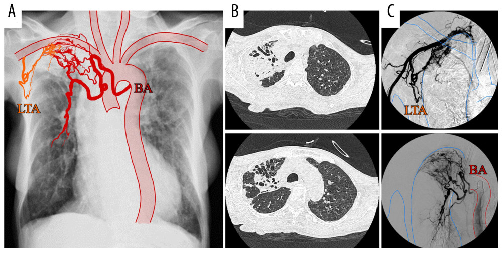(A) Chest radiography combined with a schema showing increased vascularity. (B) Chest computed tomography shows an infiltrative shadow with aspergilloma in contact with the pleura at the apex of the right lung. (C) Angiography shows proliferation of the lateral thoracic artery, and the bronchial artery flowing into the lesion. BA – bronchial artery; LTA – lateral thoracic artery.