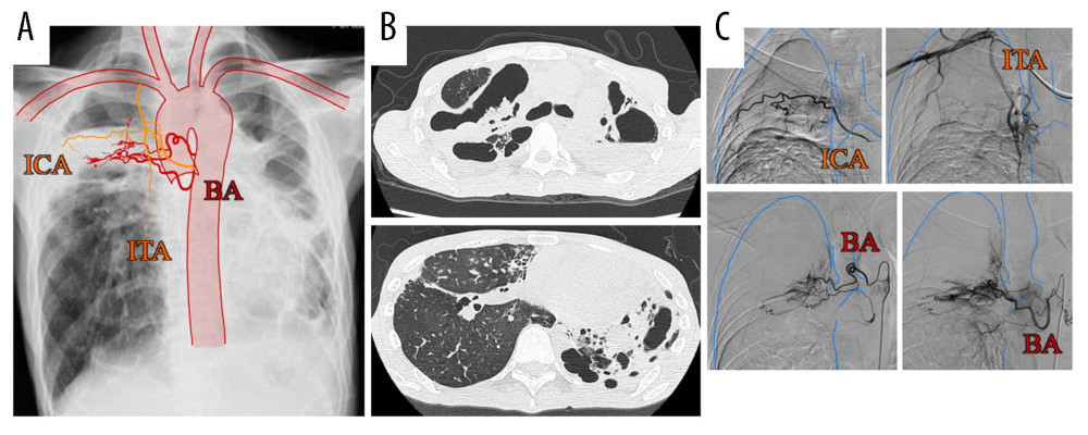 (A) Chest radiography combined with a schema showing increased vascularity. (B) Chest computed tomography shows cysts with fluid accumulation in the bilateral upper lobes of the lung. (C) Angiography shows proliferation of the intercostal artery, internal thoracic artery, and bronchial artery flowing into the lesion. BA – bronchial artery; ICA – intercostal artery; ITA – internal thoracic artery.