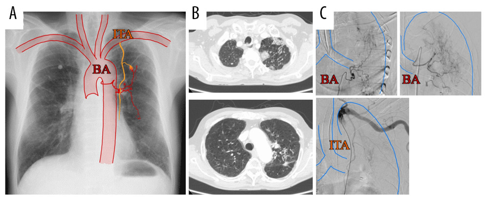 (A) Chest radiography combined with a schema showing increased vascularity. (B) Chest computed tomography shows an infiltrative shadow close to the pleura in the upper lobe of the left lung. (C) Angiography shows proliferation of the bronchial artery and internal thoracic artery flowing into the lesion. BA – bronchial artery; ITA – internal thoracic artery.