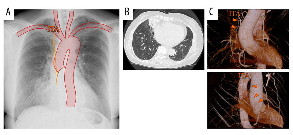 (A) Chest radiography combined with a schema showing increased vascularity. (B) Chest computed tomography (CT) shows a ground-glass opacity associated with hemorrhage in contact with the pleura on the right lung middle lobe medial segment. (C) Three-dimensional CT shows a suspected shunt from the right internal thoracic artery (triangle) to the pulmonary artery. ITA – internal thoracic artery.