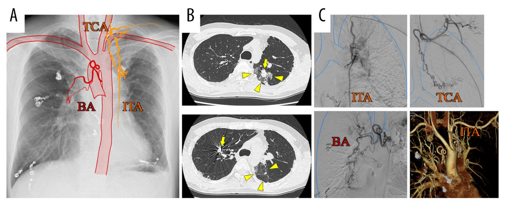 (A) Chest radiography combined with a schema showing increased vascularity. (B) Chest computed tomography (CT) shows treated pulmonary arteriovenous malformations at the left and right upper lobe (arrow). Two months after the initial embolization, chest CT shows a worsening infiltrating shadow in contact with the pleura in the left lung upper lobe (triangle). (C) Angiography shows proliferation of the bronchial artery, internal thoracic artery, and thyroid carotid artery flowing into the lesion. Four-dimensional CT also shows the dilated and tortuous left ITA flowing into the lesion. BA – bronchial artery; ITA – internal thoracic artery; TCA – thyroid carotid artery.