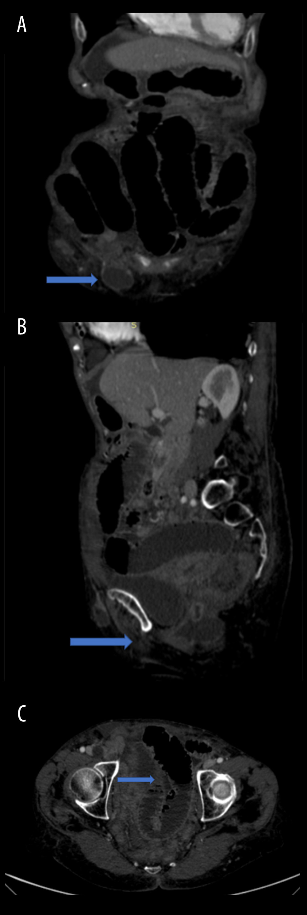 Preoperative CT scan. (A) Strangulated right groin hernia (blue arrow) – coronal view. (B) Intestinal occlusion (blue arrow) – sagittal view. (C) Air-water levels (blue arrow) – axial view of intestinal loops.