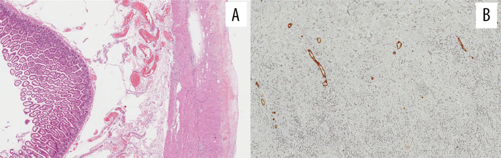 Histological profile of the lesion. (A) Proximal ileal loop showing the histological feature of ischemia: the incarcerated loop showed subacute/chronic non-specific inflammation, resulting in a slightly thickening of subserosa, while the submucosa is markedly edematous (hematoxylin & eosin; 10×). Mesenteric fibrous nodule in the distal ileal loop. (B) The fibrous nodule is composed of a proliferation of spindle-shaped cells set in a collagenized stroma hematoxylin & eosin; 40×).