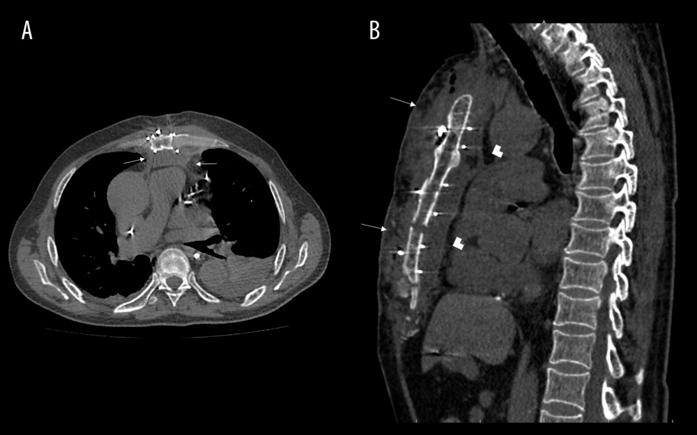 (A) Computed tomography image of a 3-tesla machine showing areas of mediastinal collections compatible with mediastinitis (arrows). (B) Computed tomography image of a 3-tesla machine showing areas of infection in the sternum (arrows) and mediastinal fluid collections (arrowheads).