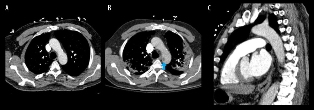 (A) Computed tomography pulmonary angiogram obtained on the patient’s initial presentation. This axial view on cross-sectional imaging demonstrates patency within the aortic arch without any thrombus visualized. (B) Subsequent computed tomography pulmonary angiogram obtained around day 10 of patient’s hospital course, when D-dimer increased 3-fold from 2350 ng/ mL to 6840 ng/mL and raised suspicion for a new thrombotic event. This axial view on cross-sectional imaging demonstrates formation of new thrombus (arrow) within the aortic arch that was not present on the previous computed tomography pumonary angiogram (Figure 1A). (C) Cross-sectional imaging from a computed tomography pulmonary angiogram obtained on the patient’s initial presentation. Again, demonstrating patency within the aortic arch without any visualized thrombus on sagittal view.