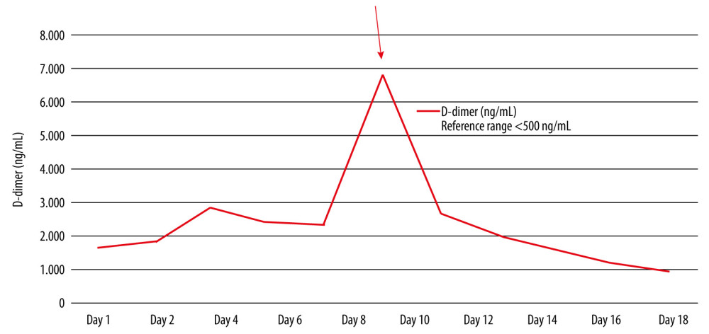D-dimer, a COVID-19 inflammatory marker, trended throughout hospitalization. X-axis represents hospital days from day 1, the first day of hospitalization, to day 18, day of hospital discharge. D-dimer was trended approximately once every 2 days; therefore, aside from days 1 and 2 and days 10 to 12, which represent 24-h time frames, all other data points are approximately 48 h apart in the patient’s hospital course. Y-axis is representative of D-dimer values in ng/mL obtained throughout hospitalization. Values are listed in 1000 ng/mL increments. Day 10 (arrow), represented on the X-axis, demonstrates the day the patient’s D-dimer rose significantly and peaked at 6840 ng/mL, as represented on the Y-axis. Close monitoring of the D-dimer trend and observation of its peak on day 10 led to further investigation with computed tomography angiography, which ultimately led to the discovery of a new aortic free-floating thrombus.