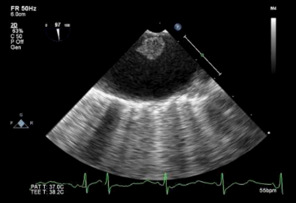 Transesophageal echocardiogram demonstrating a floating aortic thrombus. The short-axis upper esophageal view of the descending aortic thrombus on transesophageal echocardiogram showed a well-defined floating mass with irregular borders, confirming suspicion for a floating aortic thrombus.