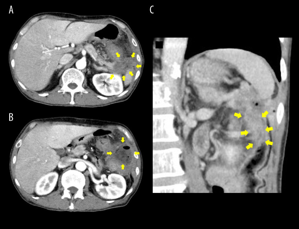 (A) Axial section view of the computed tomography images showing the pancreatic tail tumor seems to be infiltrating the other organs. Arrows indicate the pancreatic tail tumor. (B) Axial section view of the computed tomography images showing an intra-abdominal abscess near the pancreatic tail and splenic flexure of the transverse colon. Arrows indicate an intra-abdominal abscess. (C) Coronal section view of the computed tomography images showing the pancreatic tail tumor seems to be infiltrating the splenic flexure of the transverse colon. Arrows indicate compressed splenic flexure of transverse colon.