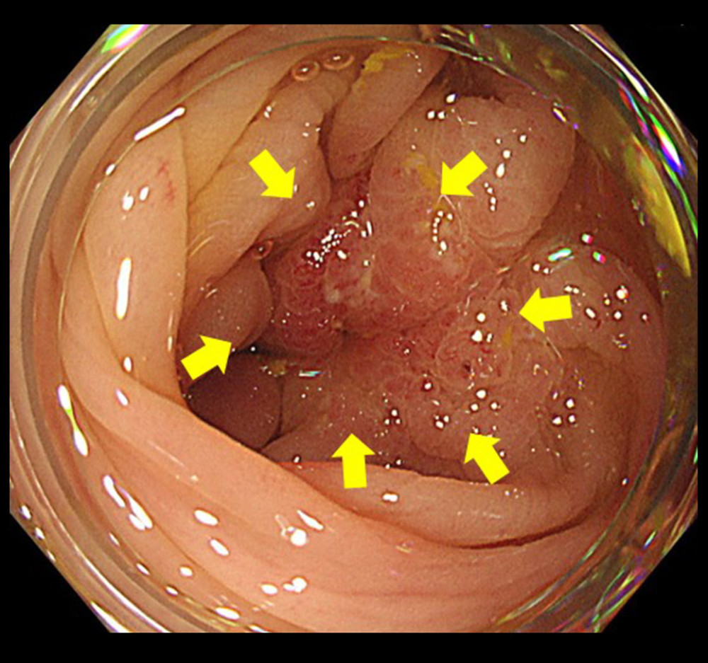 Colonoscopy image showing that the tumor appears to be compressing the descending colon from the serosal wall.