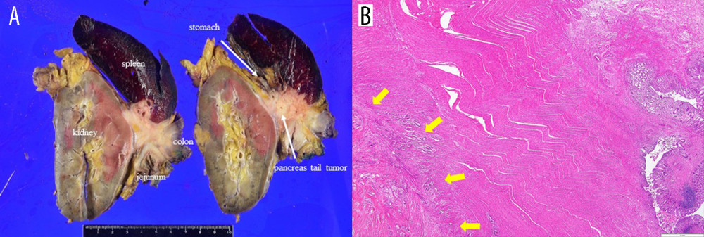 (A) Photograph of en bloc resected specimen comprising the pancreas, colon, spleen, stomach, jejunum, and kidney. (B) Photomicrograph showing tumor cells invading the colon up to the muscularis propria (hematoxylin eosin stain; magnification: ×20).
