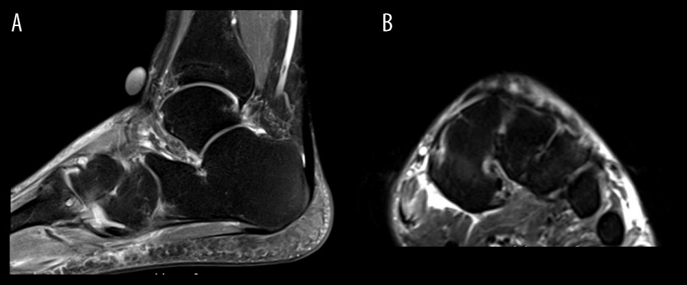 T2-weighted magnetic resonance image of left foot. (A) Sagittal view showing small subchondral cystic changes in the tarsometatarsal joint, compatible with degenerative changes. (B) Coronal view showing mild degenerative changes.