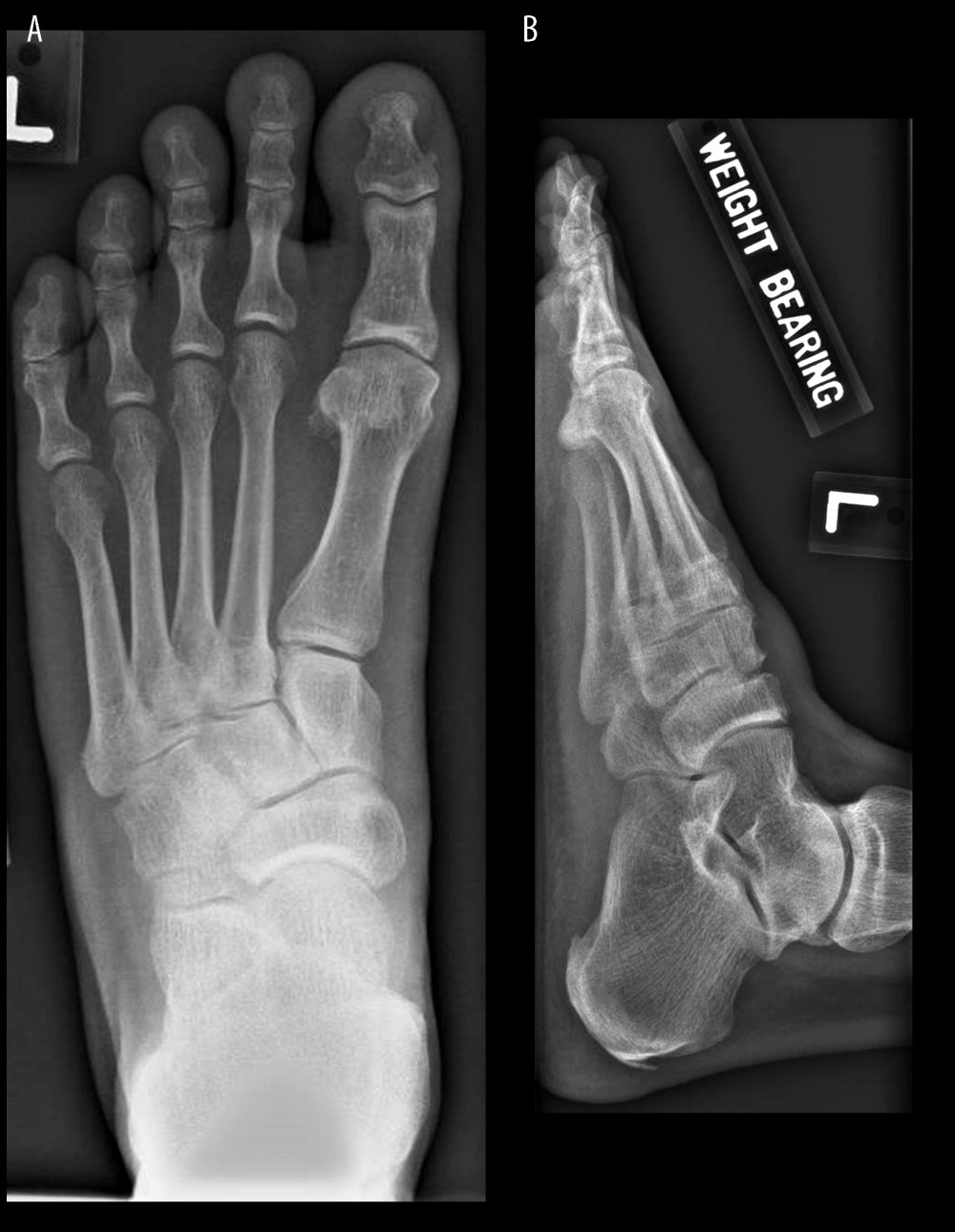 Plain radiograph of the left foot showing mild degenerative changes in 1st metatarsophalangeal joint. (A) dorsoplantar view, (B) lateral view.