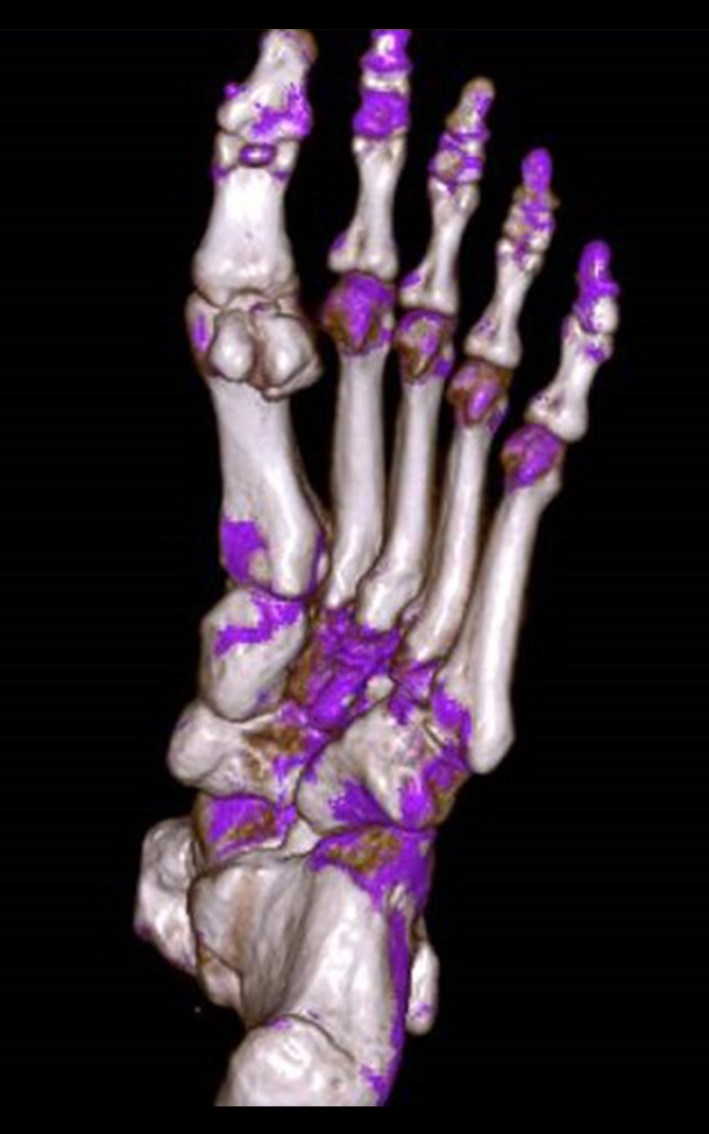 Noncontrast dual-energy computed tomography of the left foot showing the absence of monosodium urate crystal deposition. There are multiple periarticular erosions in the tarsal and metatarsal bases.
