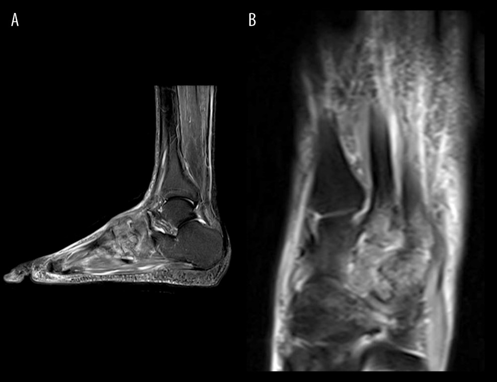 Magnetic resonance image T2-weighted of left foot (A) sagittal view of left foot showing mid foot periarticular marrow edema and erosions; (B) axial view showing 2nd–3rd tarsometatarsal joint effusion, with periarticular marrow edema and erosions.