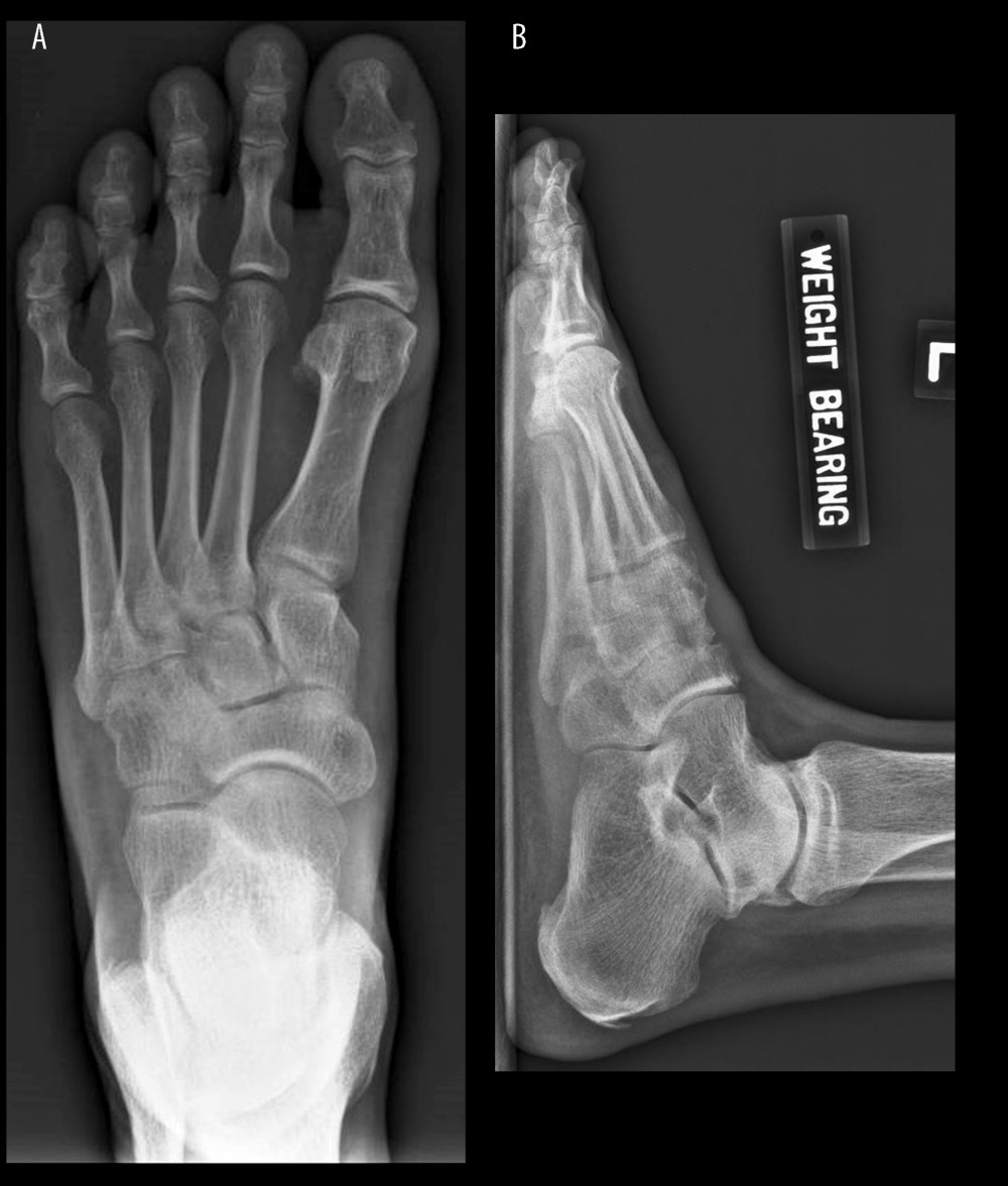 Plain radiograph of the left foot. (A) Dorsoplantar view showing loss of bony densities of the intermediate, lateral cuneiforms and cuboid with narrowing of their tarsal metatarsal joint spaces. (B) Lateral view showing cortical irregularity and lucencies in the anterosuperior aspect of navicular and cuneiform bones.