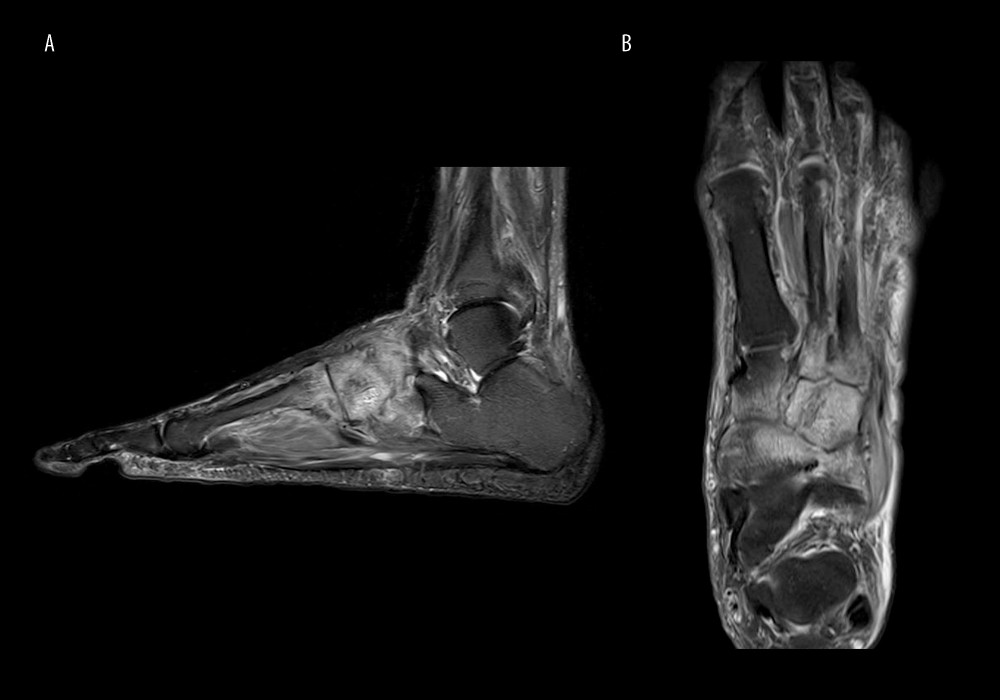 Magnetic resonance image T2-weighted of left foot showing interval worsening in extensive peri-articular marrow edema with increased bony erosions. Joint effusion and synovitis of the midfoot and 2nd to 5th tarsometatarsal joints with increased surrounding reactive subcutaneous soft tissue, plantar and interosseous muscular oedema/enhancement. (A) sagittal view, (B) axial view.
