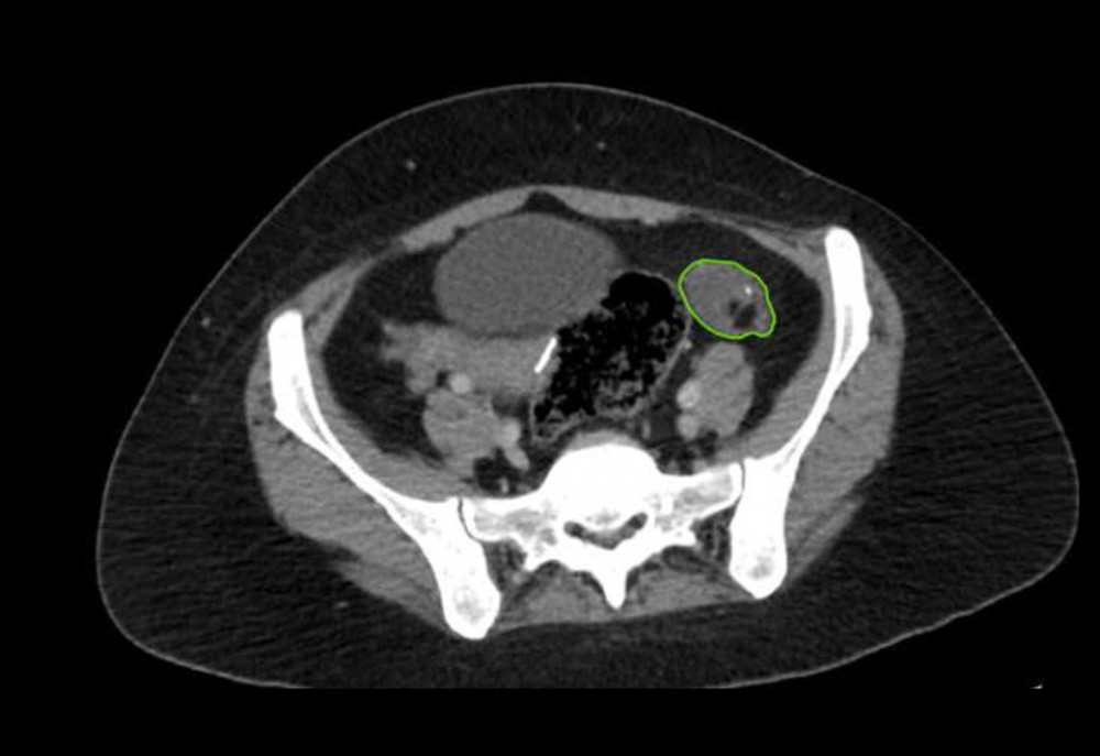 A dermoid cyst measuring approximately 3.2×2.5 cm is seen in the left ovary (marked in green).