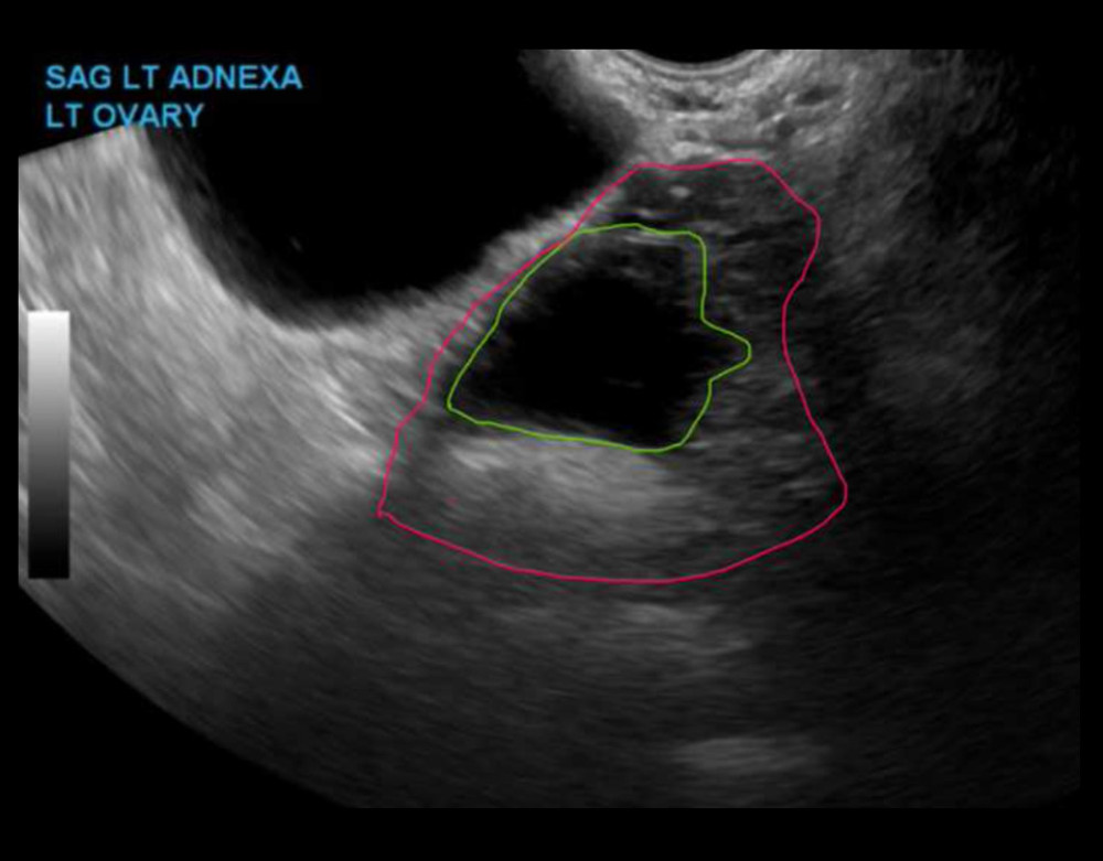 Computed tomography (CT) was concerning for a left ovarian dermoid cyst and sagittal ultrasonography of the left ovary corroborated those findings. The left ovary (marked in red) measured 4.4×4.3×2.6 cm. A cystic lesion (marked in green) measuring 2.6×3.4×3.5 cm was found within the ovary, corresponding to the dermoid cyst seen on the previous CT.