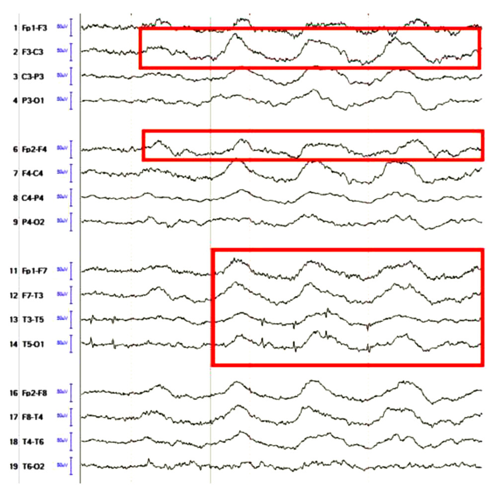 Tracings showing abundant runs of slowing rhythmic delta activity with superimposed beta activity. These clusters of rhythmic delta activity last up to 12 s, at 1.5 to 2 Hz.