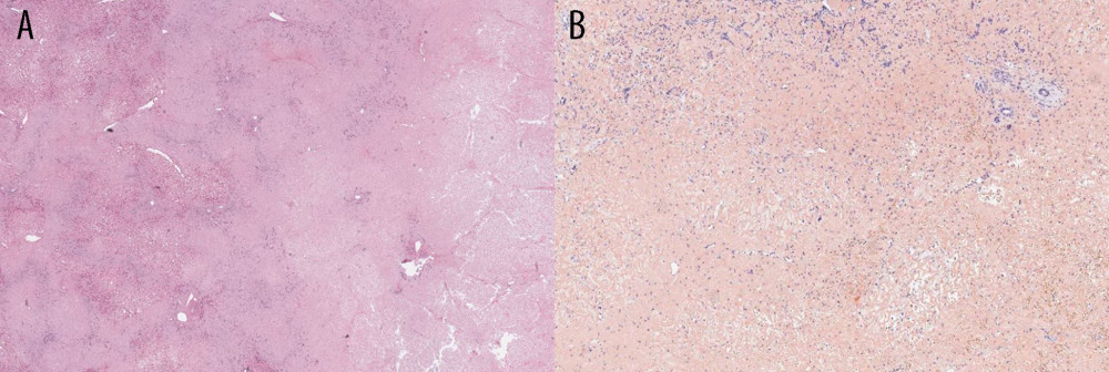 Liver biopsy stained positive for Congo Red, consistent with hepatic amyloidosis. (A) H&E stain (B) Congo Red stain.