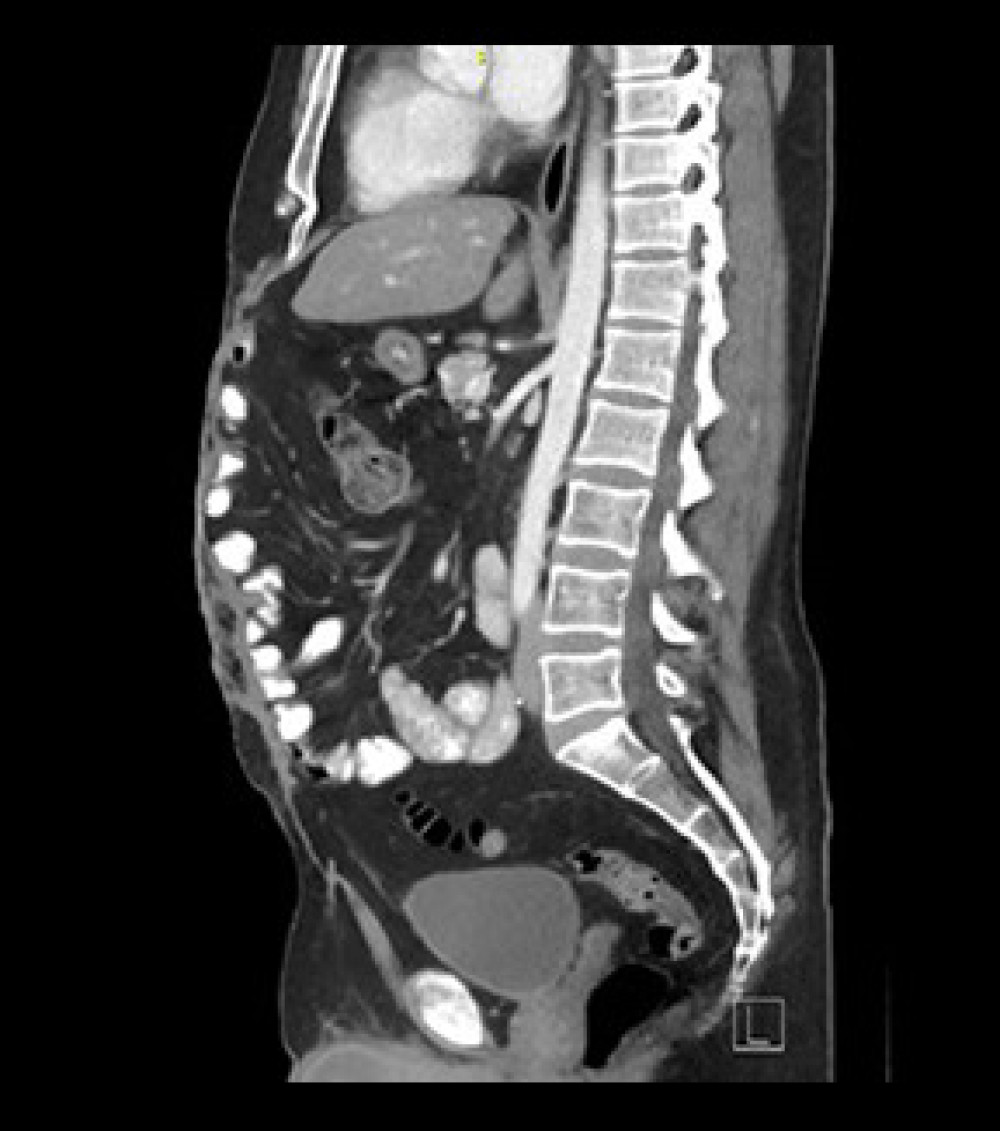 Sagittal view of abdomen 2.5 years following resection, with no evidence of recurrence.
