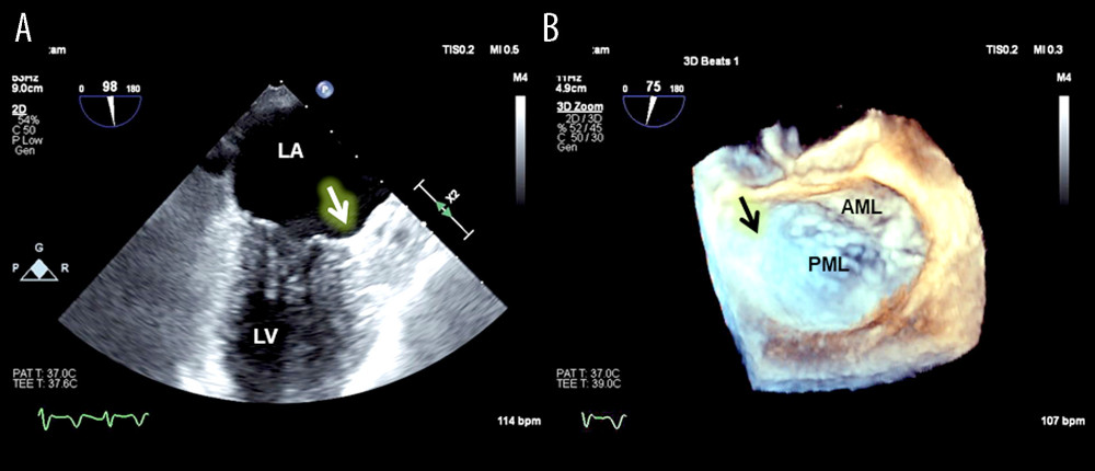 Transesophageal echocardiography (TEE) images showing an undeterminable left atrial appendage (LAA) both on the 2-dimensional long-axis view (A) and on the 3-dimensional real-time image of the surgeon view (B). Arrows indicate where the LAA should be located. AML – anterior mitral leaflet; LA – left atrium; LV – left ventricle; PML – posterior mitral leaflet.