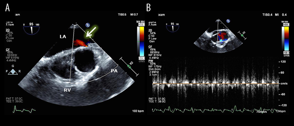 A jet signal on color-flow mapping spewed out into the main left atrium (LA) from where the left atrial appendage (LAA) might be located (A) and flow-velocity spectrum obtained with the pulsed Doppler sample volume placed at the jet signal (B). PA – pulmonary artery; RV – right ventricle.