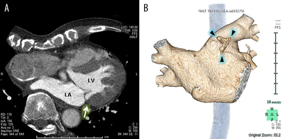 Computed tomography (CT) angiographic images of the heart showing an interminable left atrial appendage (LAA) on the routinely developed tomography (A) and a small, stalk end-like LAA (arrow heads) demonstrated by multiplanar 3-dimensional volume rendering (B). The arrow points to the area where the LAA would have been visible. LA – left atrium; LV – left ventricle.